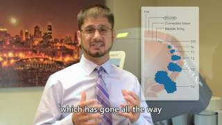 Bladder Cancer Basics