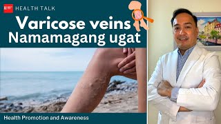 Namamagang ugat (Varicose veins)