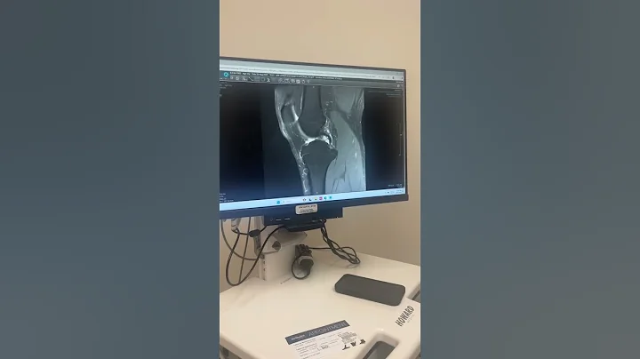 First time trying Fentanyl and Oxy. ACL Surgery #aclsurgeryrecovery #houston #houstonmethodist