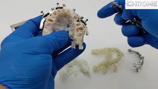 Bone Reduction Steps
