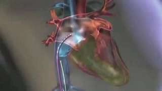 Аритмология Фибрилляция Catheter Ablation For Atrial Fibrillation AFIB