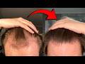How I Recovered My Hairline Without A Transplant (3-Year Evolution)