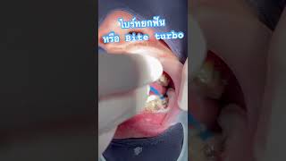 Bite turbo เป็นเครื่องมือที่ใช้สำหรับคนไข้จัดฟันที่มีปัญหาการสบฟัน #ช่องยิ้มสวย #จัดฟันครั้งแรก