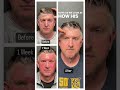 Anthony | 2 Month Follow Up | Male Brow Lift &amp; Eyelid Surgery | Clinic 5C