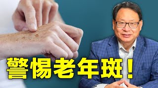 老年斑給我們傳遞什麼健康警訊？老年斑裡面有什麼有害物質？大腦也會長老年斑？