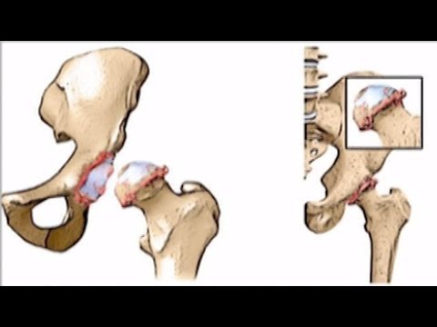 Видео: Асептична некроза - етапи, асептична некроза на костите, главата на бедрената кост, тазобедрената и колянната става, раменната кост и талуса