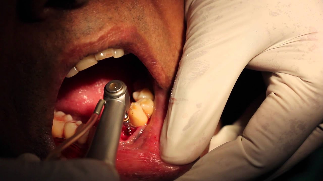 Immediate Dental Implants just after tooth extraction. Done by Dr