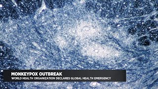Stanford Health Care doctor discusses monkeypox outbreak