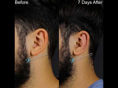 Otoplasty Surgery |