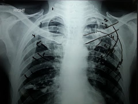 Bagaimana menghitung Ribs di Dada X Ray? Dalam 5 menit!