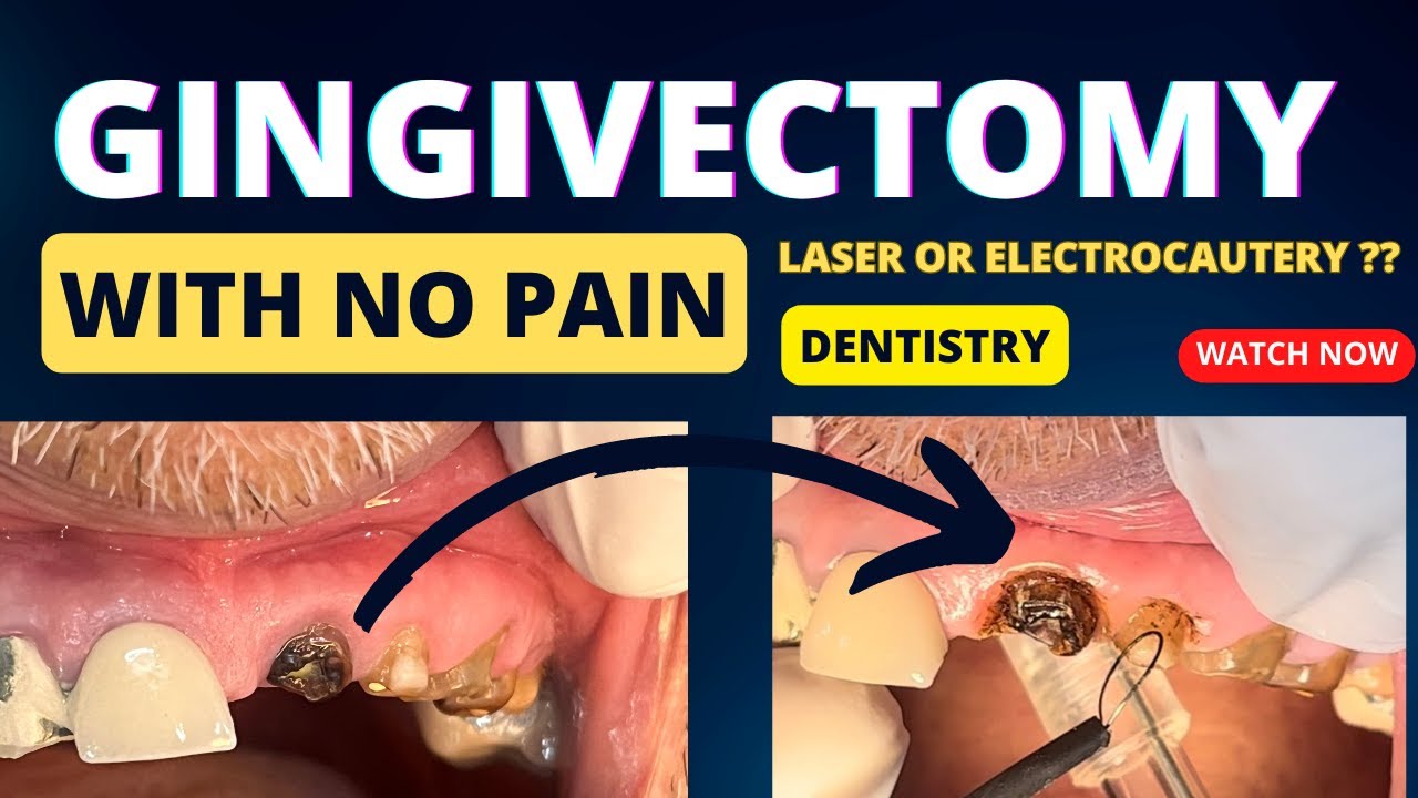 ELECTROCAUTERY IN DENTISTRY GINGIVECTOMY IN DENTISTRY LASER USE IN