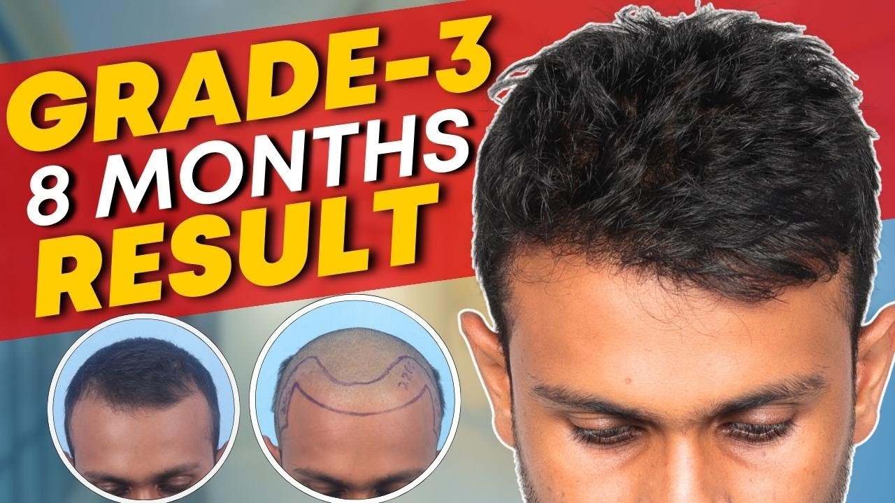 Hair Transplant in Chennai Best Results & Cost of Hair Transplant in Chennai YouTube