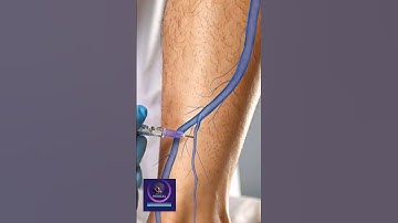 Sclerotherapy Surgery for Varicose Veins Treatment: A Complete Guide