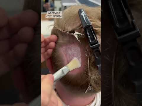 Видео: Система волос при рубцовой алопеции. Подробности в описании