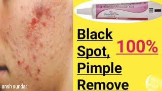 deriva bpo gel review | benzoyl peroxide gel 2.5 | bpo gel honest review | acne treatment | scars screenshot 2