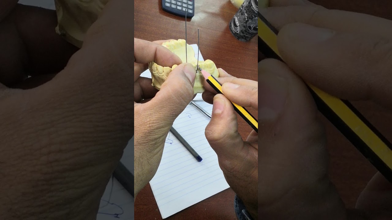 طريقة عمل (adam clasp) الدكتور مدحت العماوي