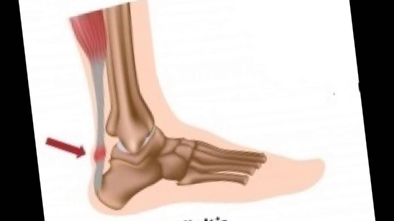 דלקת וכאב בגיד האכילס - טיפול בפציעות  ספורט ד
