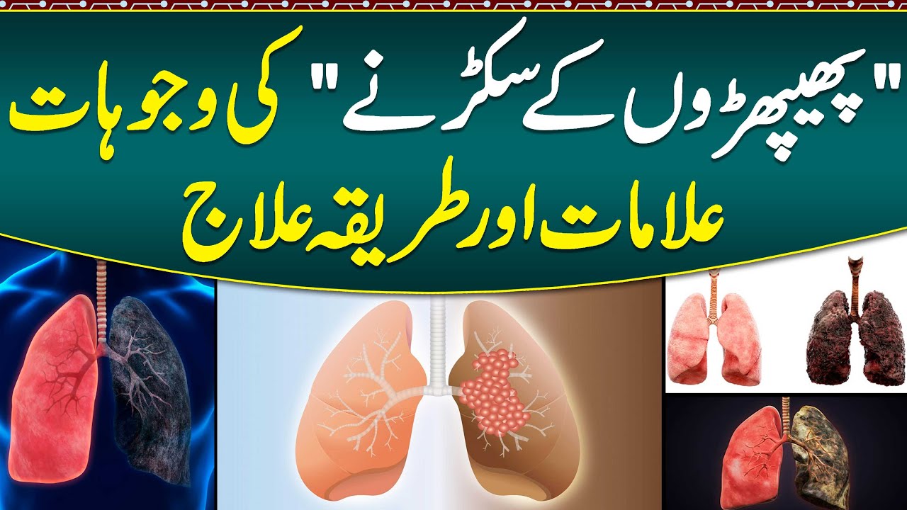 Lungs La Sukarna Ka ilaj- Lungs Fibrosis Ka ilaj - Pulmonary Fibrosis Causes & Treatment- Lungs Care