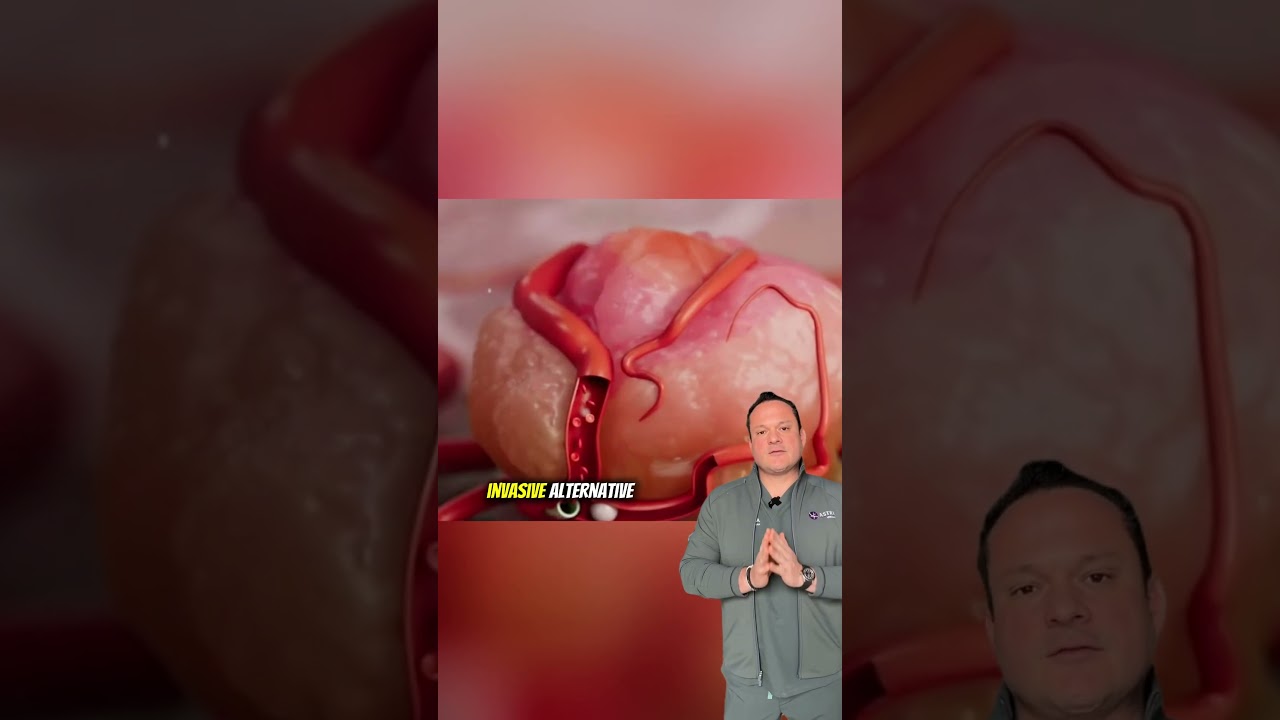 Uterine Fibroid Embolization: A Simple Solution for Fibroids!