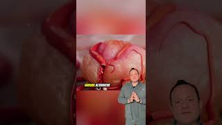Uterine Fibroid Embolization: A Simple Solution for Fibroids! Uterine Fibroid Embolization: A Simple Solution for Fibroids!