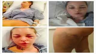 Famous War Machine's Ex, Christy Mack, Releases Statement and Graphic Photos of Alleged Assault Wealth