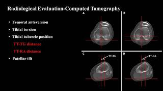 How to Evaluate and Treat Skeletally Mature Patients With Patellar Dislocation