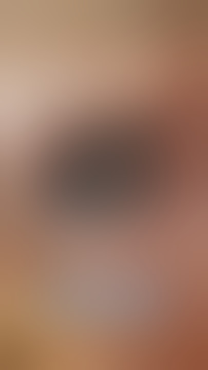 Otomyiasis - Maggots in ear