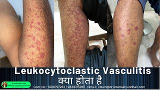 Leukocytoclastic Vasculitis Sudden Red Rashes Red Spot On Leg Palpable Purpura Dr Uttam Lenka