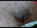 再アップ！ほくろの毛を引っこ抜く！Hair of a mole!
