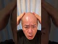 【悲報】俺のデコ、拡大が止まらない。www 😂😂