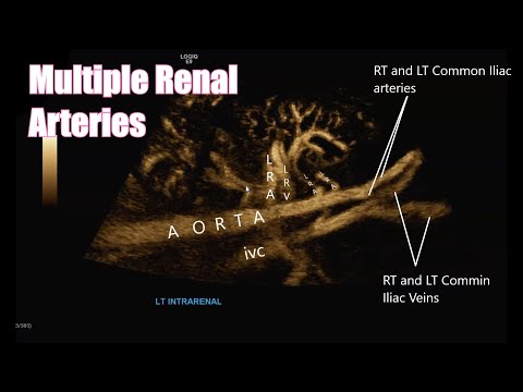 Image of Multiple Renal Arteries