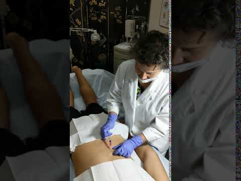 Neural Therapy Injections