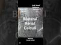 #bilateral renal calculi #urology