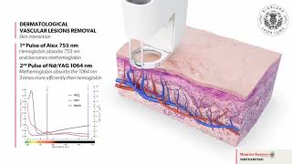 Vein Removal