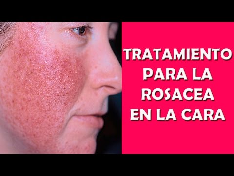 Tratamiento Para La Rosacea en la Cara : Remedios Naturales para el Acne Rosacea