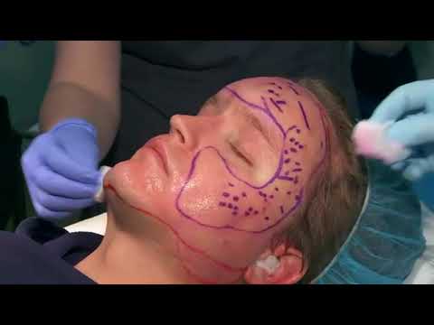 Masters Circuit: Acne Scar Treatment Preview