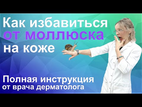 Моллюск контагиозный это/Лечение моллюска на коже у детей и взрослых