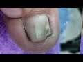 BIG TOES ONLY, HOW TO PEDICURE TRANSFORMATION FOR MEN ON DETACHED TOENAIL.