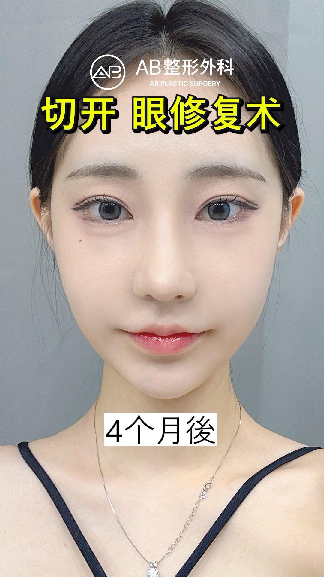 看不出來是同一個人…二次手術震撼曝光 #shorts