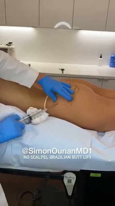 No Scalpel BBL