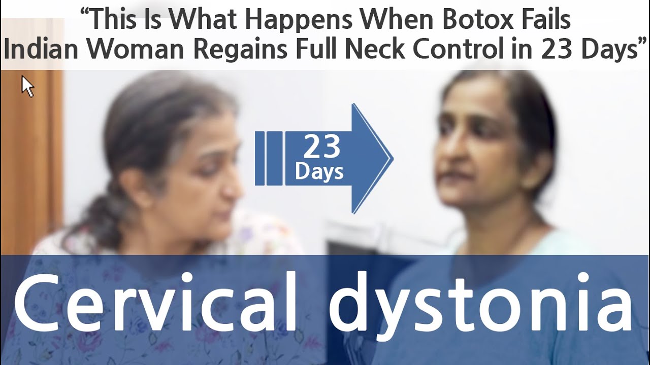 “This Is What Happens When Botox FailsIndian Woman Regains Full Neck Control in 21 Days”