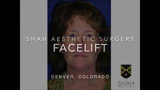 Facelift Before and After Denver - Manish H. Shah, MD, FACS