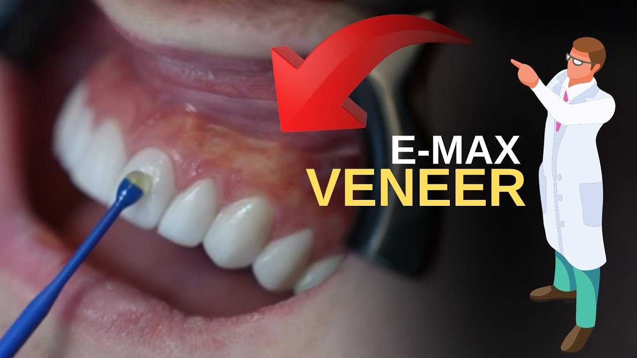 How to Emax Veneer Dental Treatments in Turkey Antalya YouTube