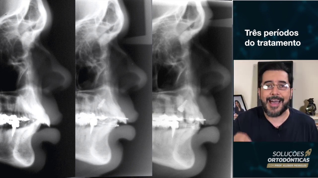 O momento certo de fazer extrações em casos de classe II.