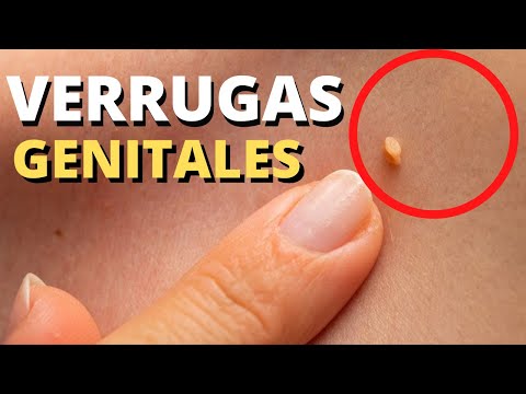 Vídeo: Verrugas De Mosaico: Tratamientos, Prevención, Síntomas