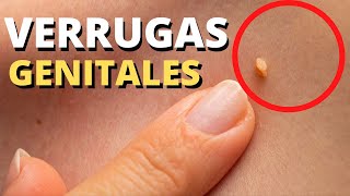 Virus del papiloma tratamiento y prevencion. Papiloma que es sintomas y tratamiento