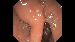 Endoloop polypectomy for Brunners adenoma