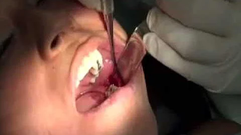 Ciruga de tercer molar inferior izquierdo Dr. Herb...