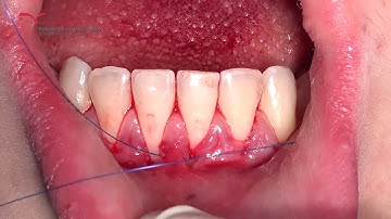 Connective Tissue Graft (FGG) & Tunnel Technique in Severe Thin Periodontion