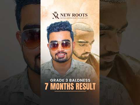 Grade 3 Baldness Hair Transplant in Aurangabad | 7 Months Result #hairtransplant #aurangabad #shorts